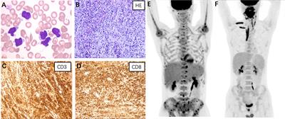 Germline defects of familial hemophagocytic lymphohistiocytosis-related genes presenting as adult-onset peripheral T-cell lymphoma
